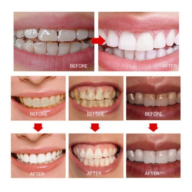 MELAO Teeth Whitening Gel Pen Yellow Teeth Dental Plaque Brighten Teeth Oral Care  Tooth Cleaning